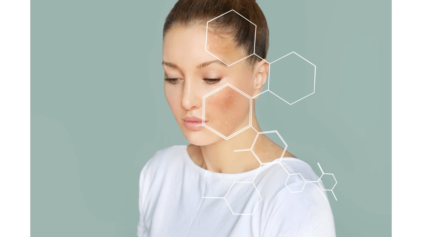 Pigmentstörungen – Altersflecken und Melasma